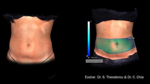 Evolve Trim Cellulite Treatment Results